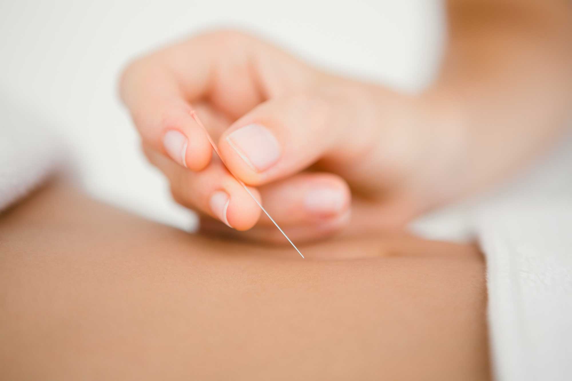 Acupuncture treatment