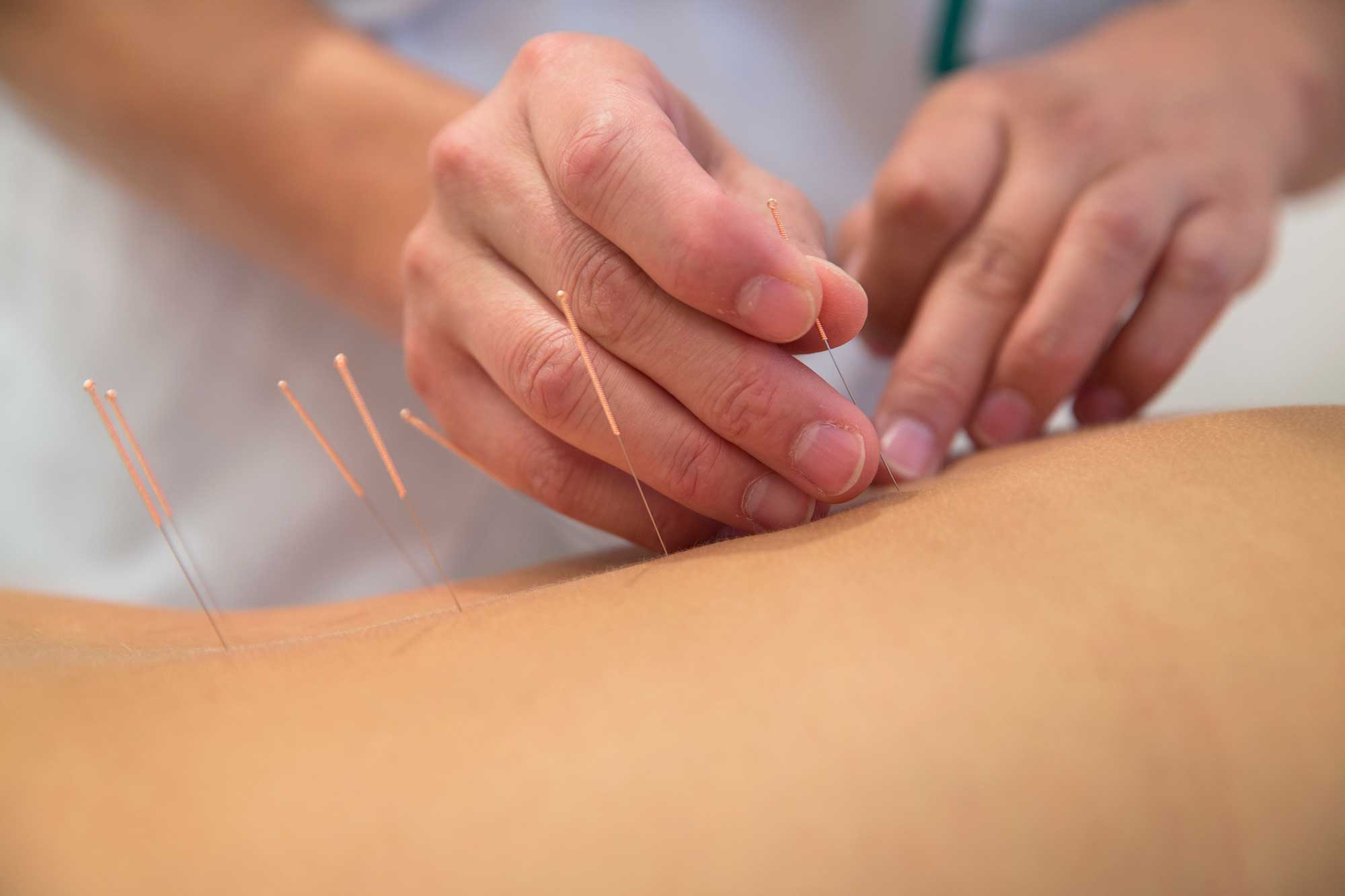 KC-Wong-5 Acupuncture